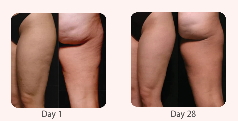 Jessica showing smoother, cellulite-free legs