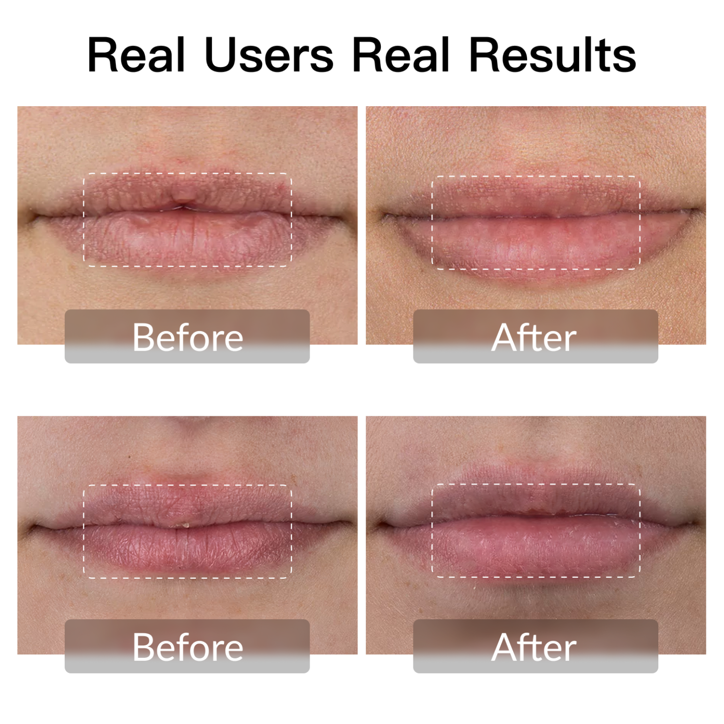 Swirise LED Light Therapy Device for Lip