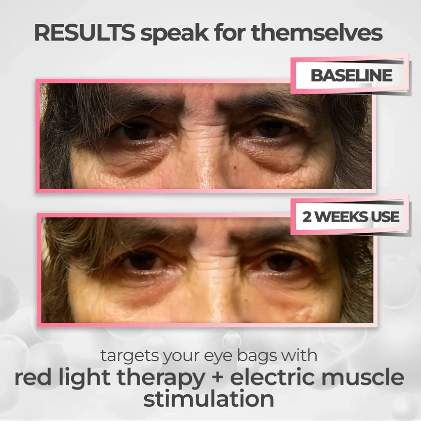 RevitalEyes® 2-in-1 Red Light Therapy + EMS To Erase Eye Bags