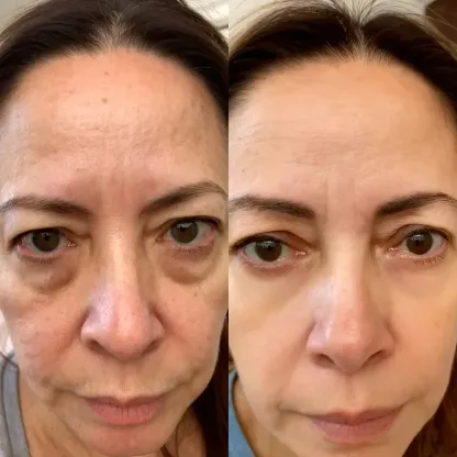 RevitalEyes® 2-in-1 Red Light Therapy + EMS To Erase Eye Bags