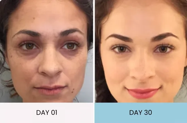 Laura's eye bags improvement before and after