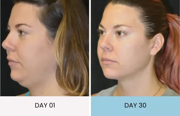 Natalie's double chin improvement before and after