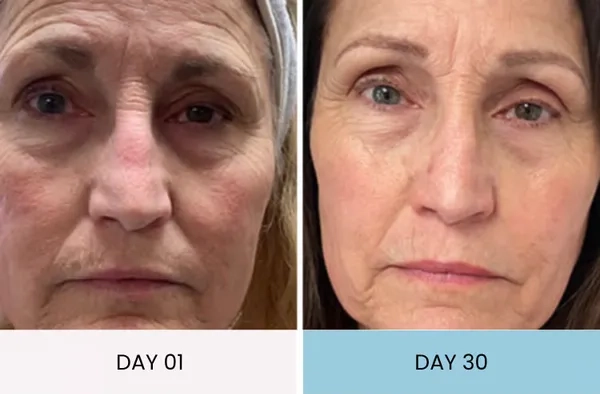 Olivia's fine lines improvement before and after