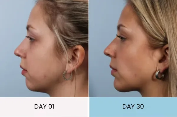 Sarah's puffy face improvement before and after