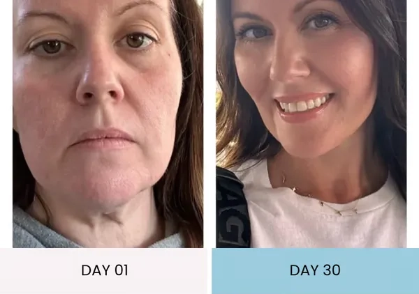 Emily's turkey neck improvement before and after