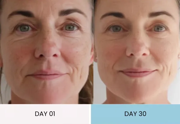 Claire's wrinkles improvement before and after