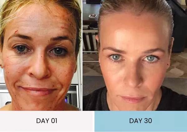 Linda's saggy skin improvement before and after