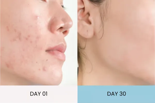 Rachel's acne improvement before and after