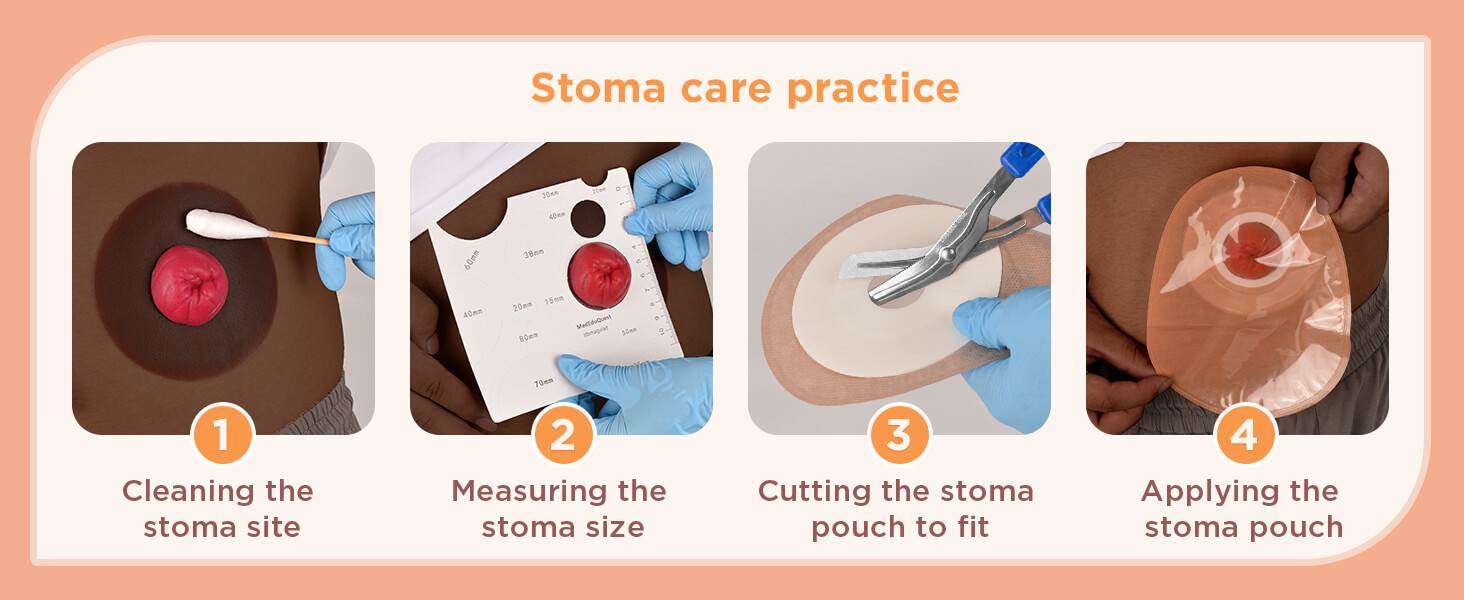 Use Stoma Models Set for Stoma Care Practice