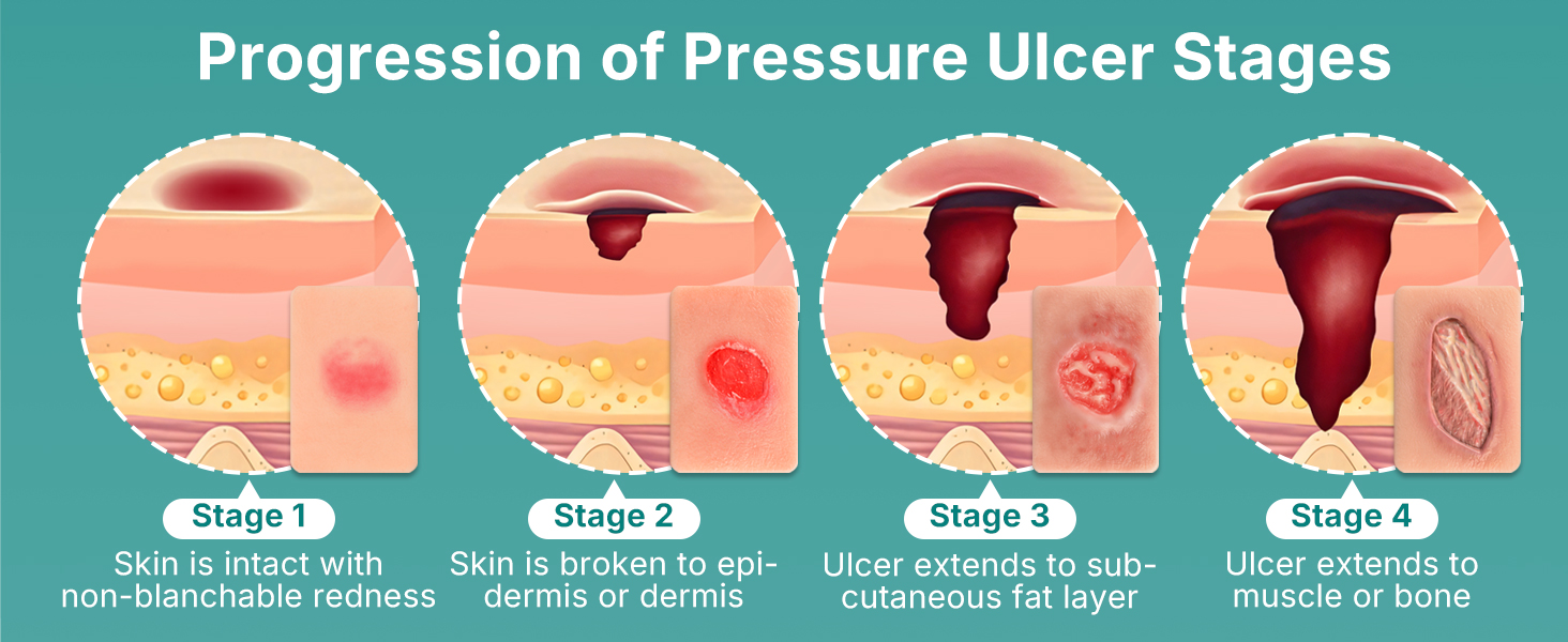 Handheld Pressure Ulcer Wound Progression
