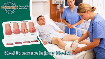 Heel Pressure Injury Stages Demonstration Model (Stage I–IV)
