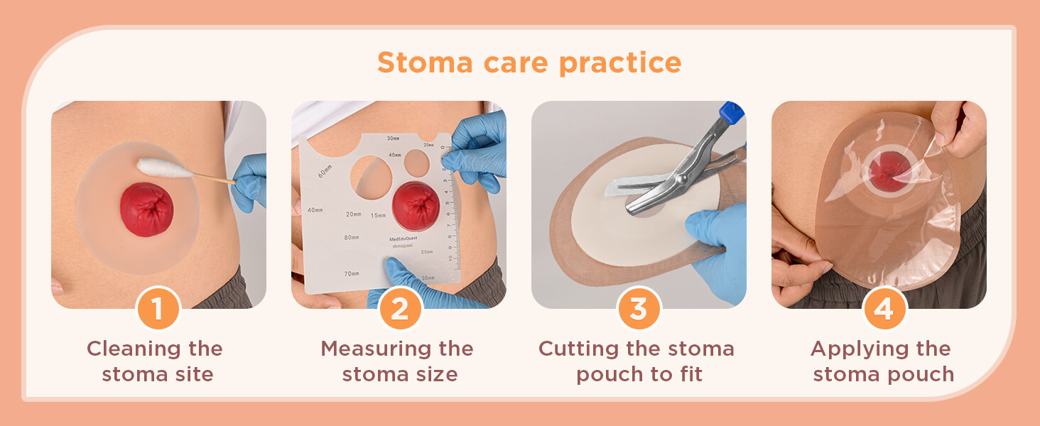 Sticky Colostomy Care Training Simulators, Light Skin Tone