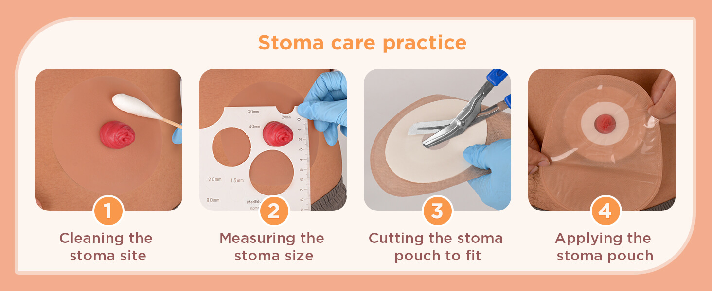 Sticky Ileostomy Stoma Care Training Model Set, Multi-Skin Tone