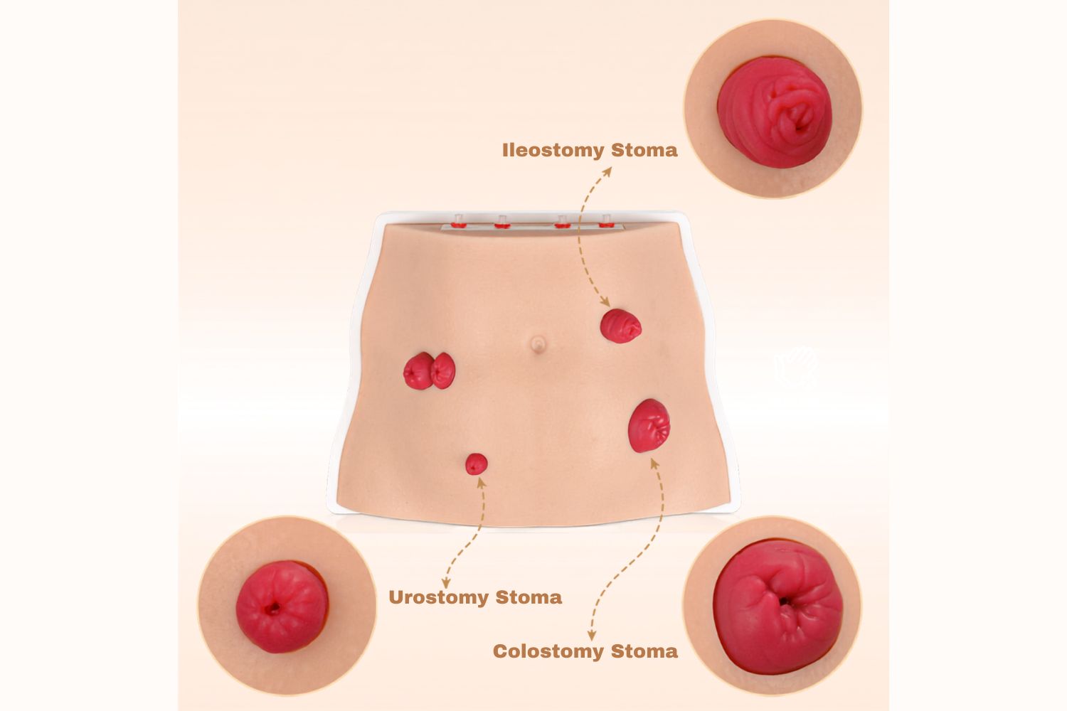 Colostomy vs Ileostomy vs Urostomy