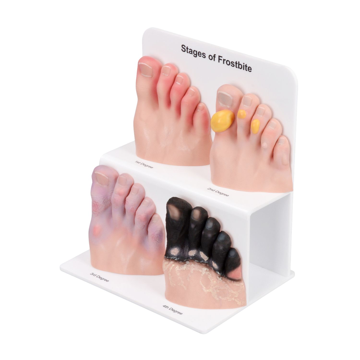 Foot Toe Frostbite Pathology Teaching Model (Stages I–IV)