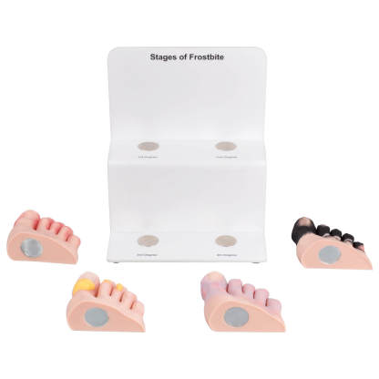 Foot Toe Frostbite Pathology Teaching Model (Stages I–IV)