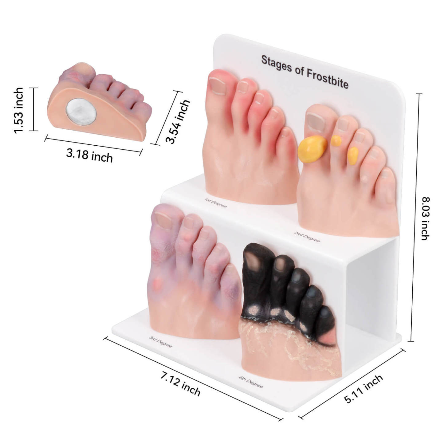 Foot Toe Frostbite Pathology Teaching Model (Stages I–IV)