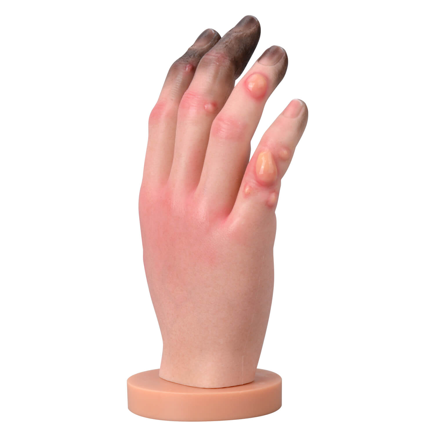  Frostbite Pathology Teaching Hand Model (Stages I–IV Progression)