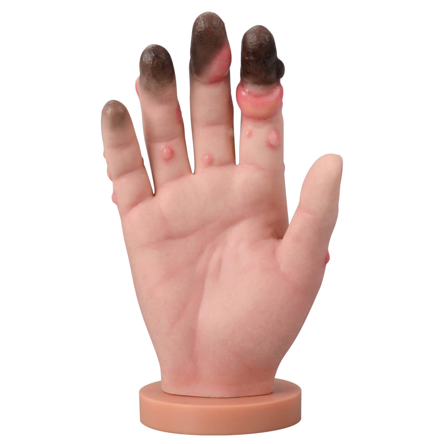  Frostbite Pathology Teaching Hand Model (Stages I–IV Progression)
