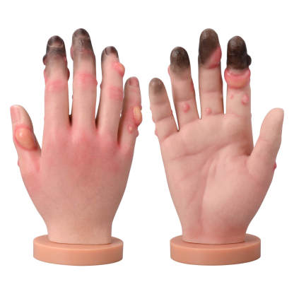  Frostbite Pathology Teaching Hand Model (Stages I–IV Progression)