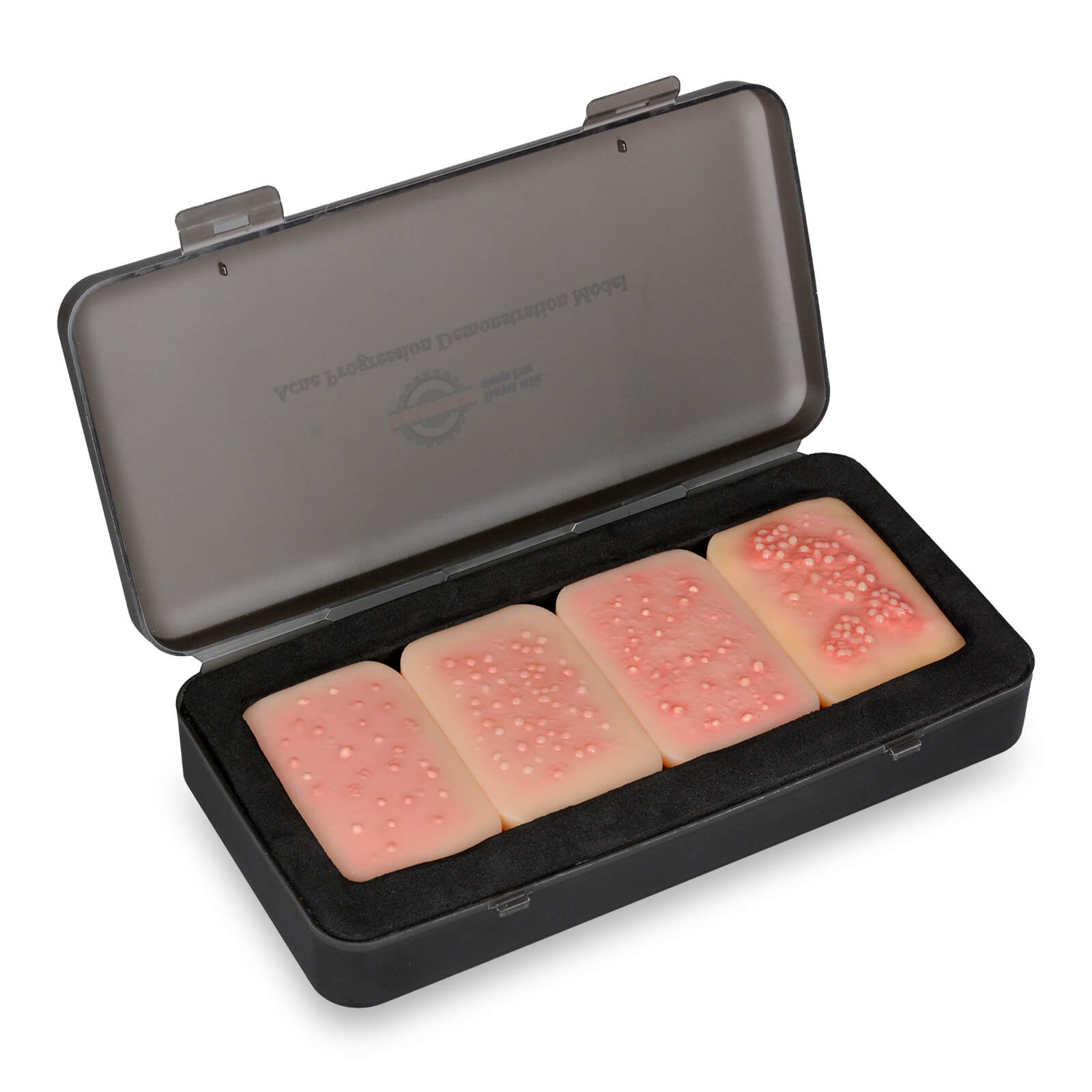 Acne Progression Teaching Model (Grades I–IV)