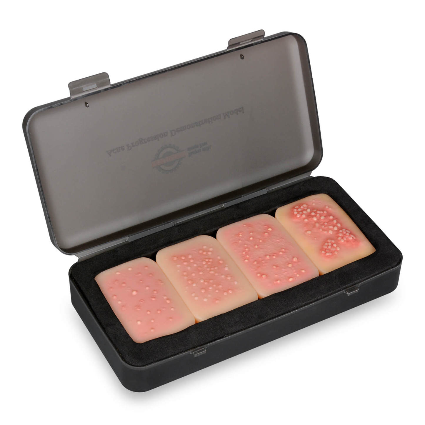 Acne Progression Teaching Model (Grades I–IV)