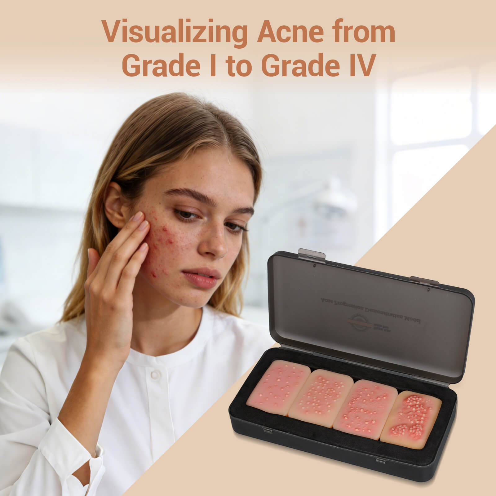 Acne Progression Teaching Model (Grades I–IV)