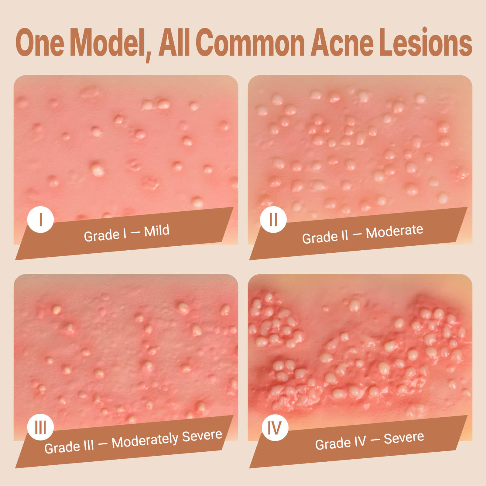 Acne Progression Teaching Model (Grades I–IV)