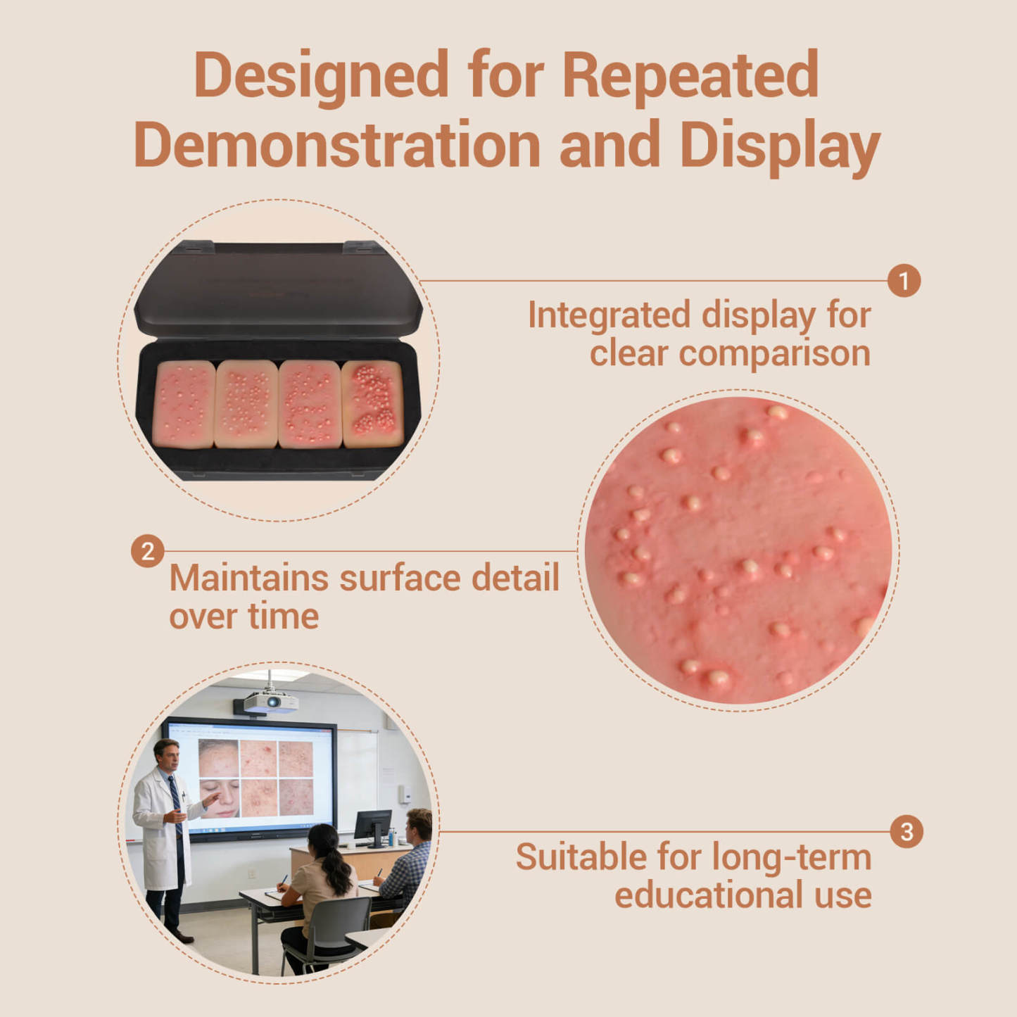 Acne Progression Teaching Model (Grades I–IV)