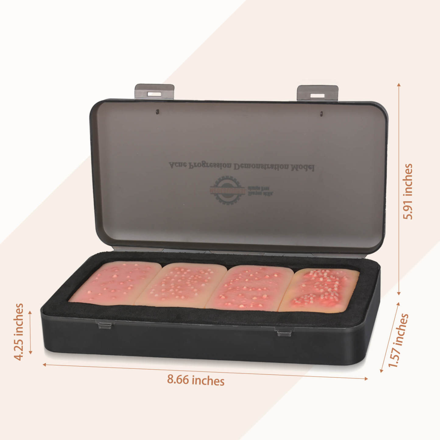 Acne Progression Teaching Model (Grades I–IV)