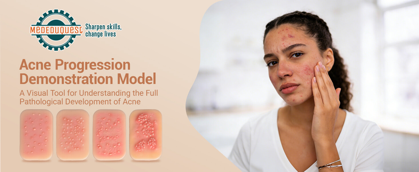 Acne Progression Teaching Model (Grades I–IV)