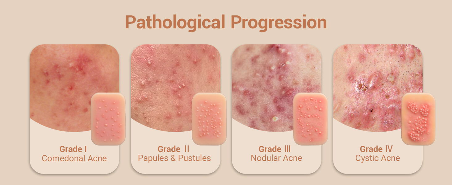 Acne Progression Teaching Model (Grades I–IV)
