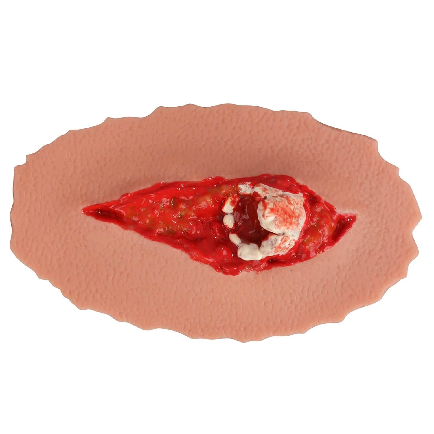 Adhensive Open Fracture Wound Moulage Grade 2