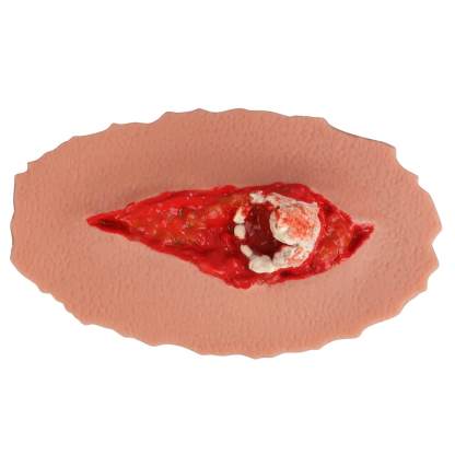 Adhensive Open Fracture Wound Moulage Grade 2