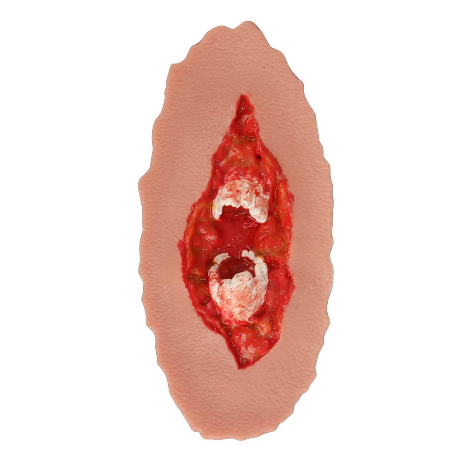 Adhesive Open Fracture Wound Moulage Grade 3
