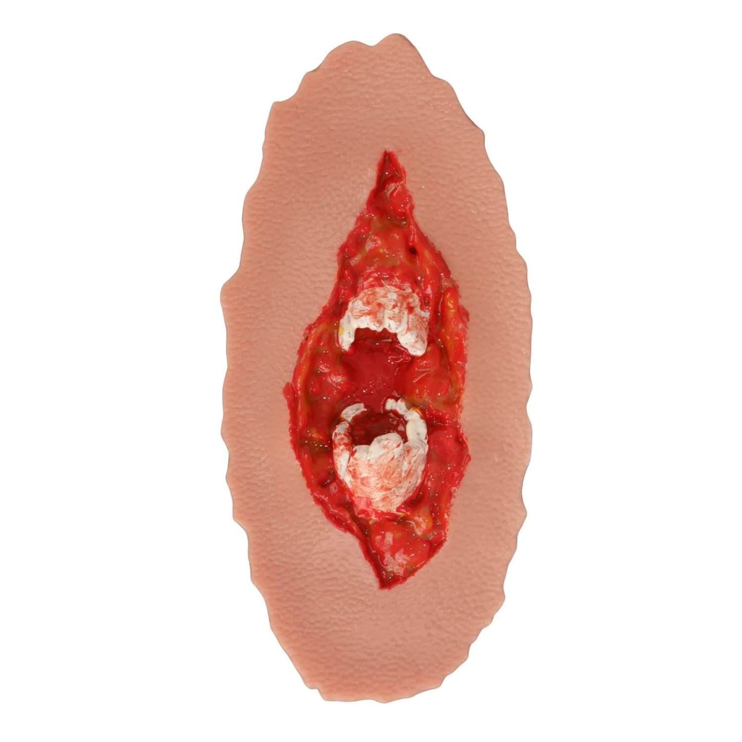 Adhesive Open Fracture Wound Moulage Grade 3