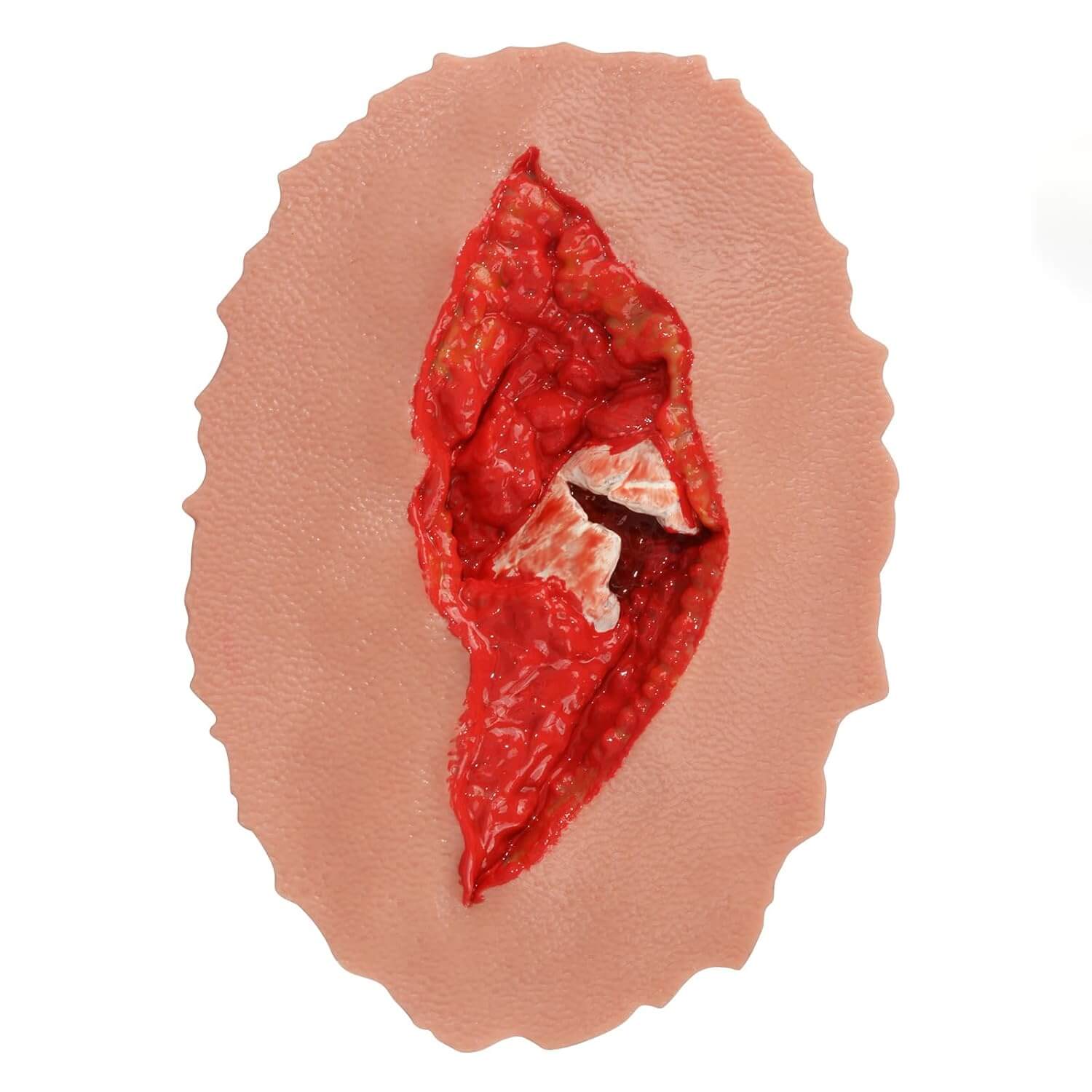 Adhensive Open Fracture Wound Moulage Grade 4