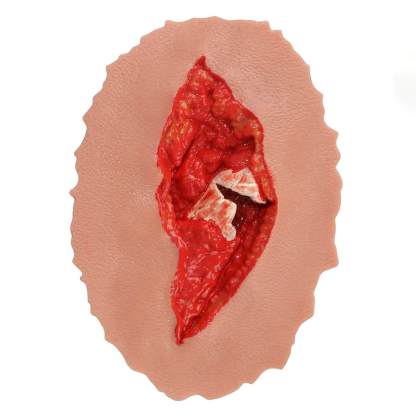 Adhensive Open Fracture Wound Moulage Grade 4