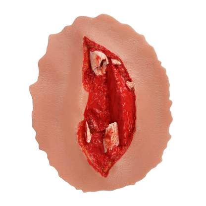 Adhensive Open Fracture Wound Moulage Grade 5