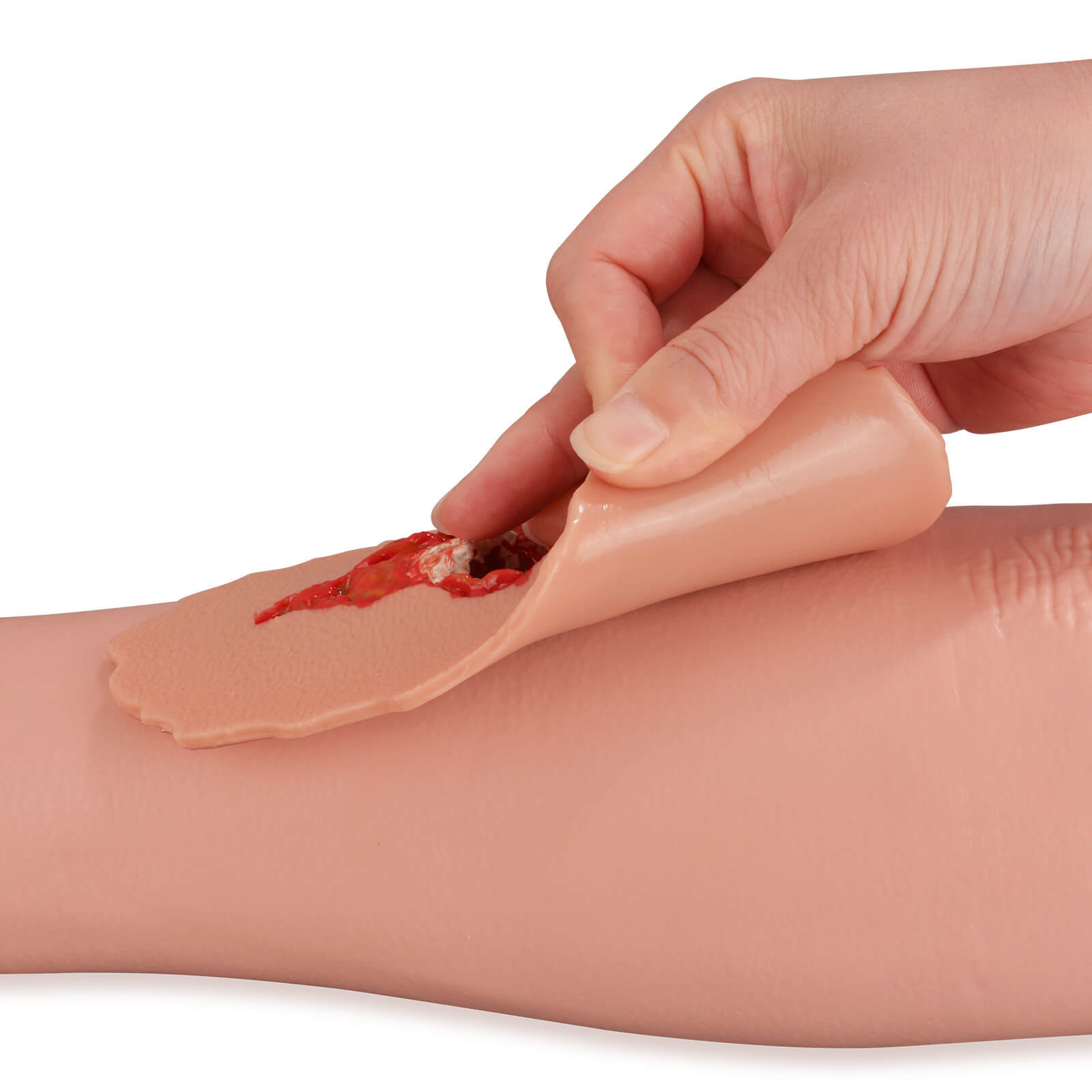 Adhensive Open Fracture Moulage