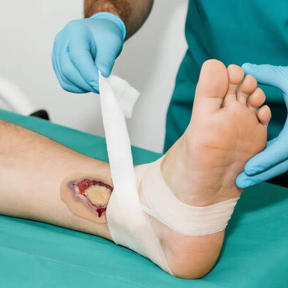 Self-Adhesive Ankle Fracture Wound Model