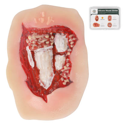 Adhesive Open Leg Fracture Wound Model