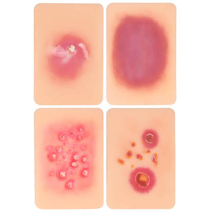 Palm-Sized Bacterial Skin Infection Wound Models