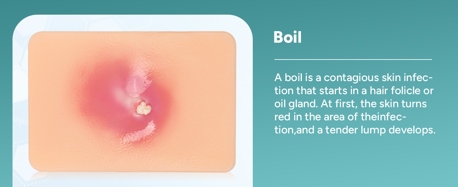 Bacterial Infected Wound Model - Boil
