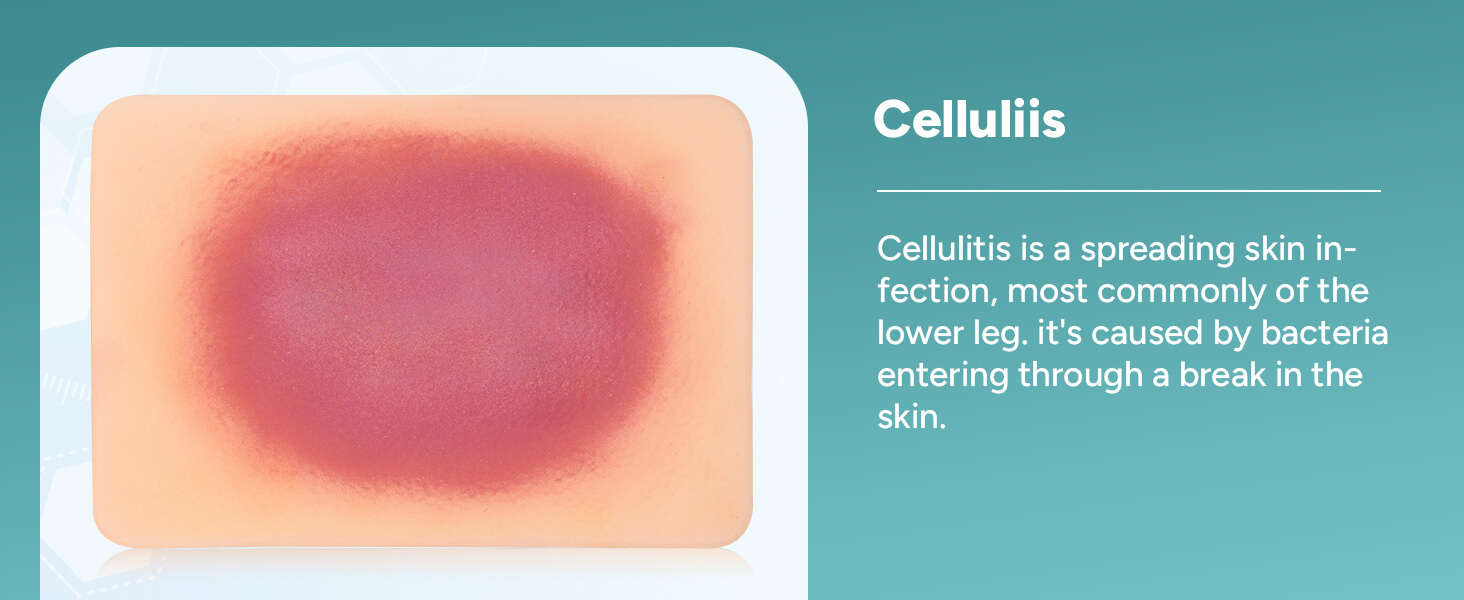 Bacterial Infected Wound Model - Celluliis