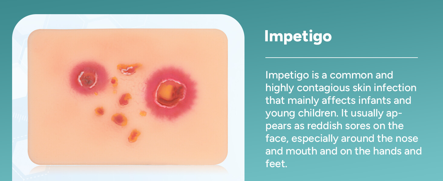 Bacterial Infected Wound Model - Impetigo