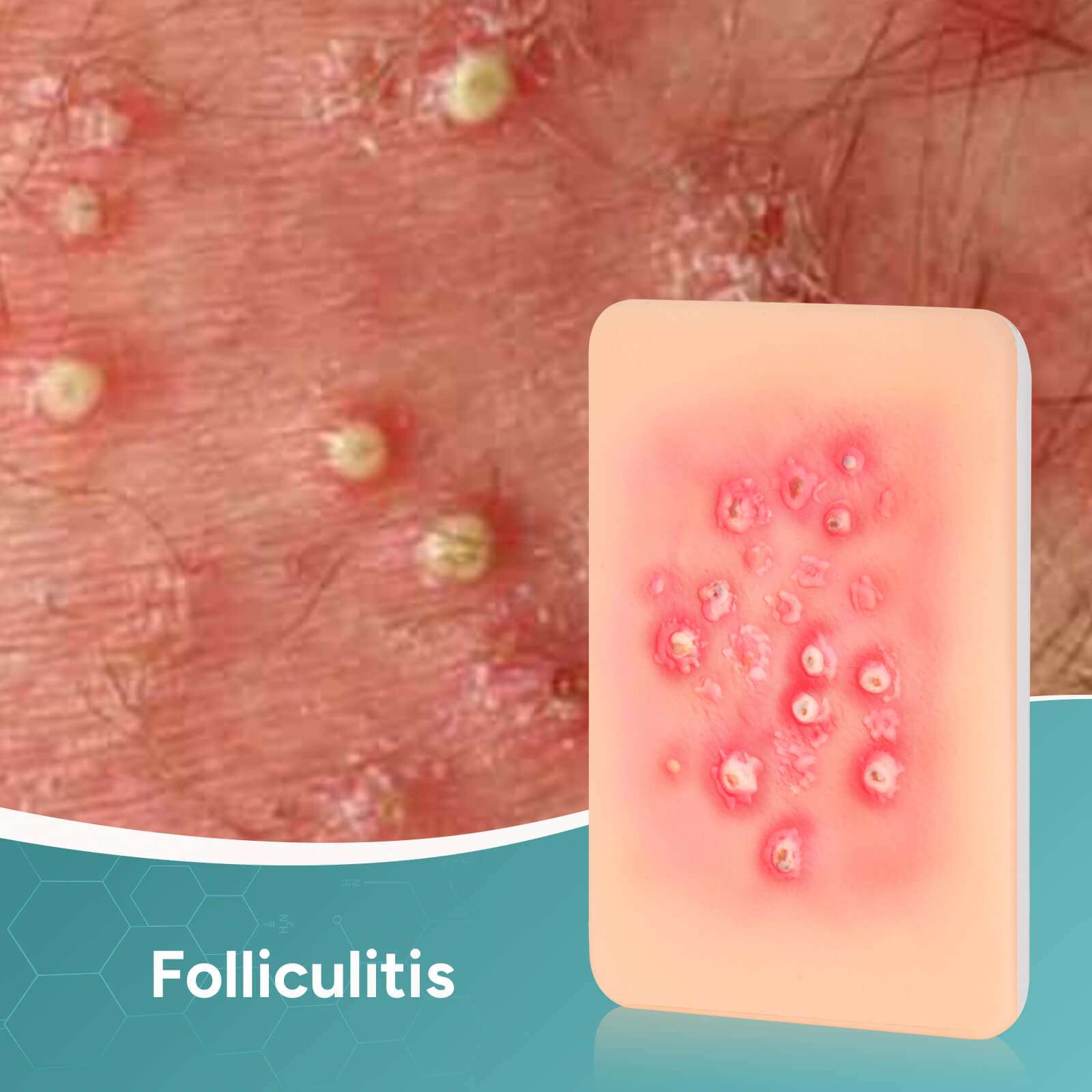 Palm-Sized Bacterial Skin Infection Wound Models