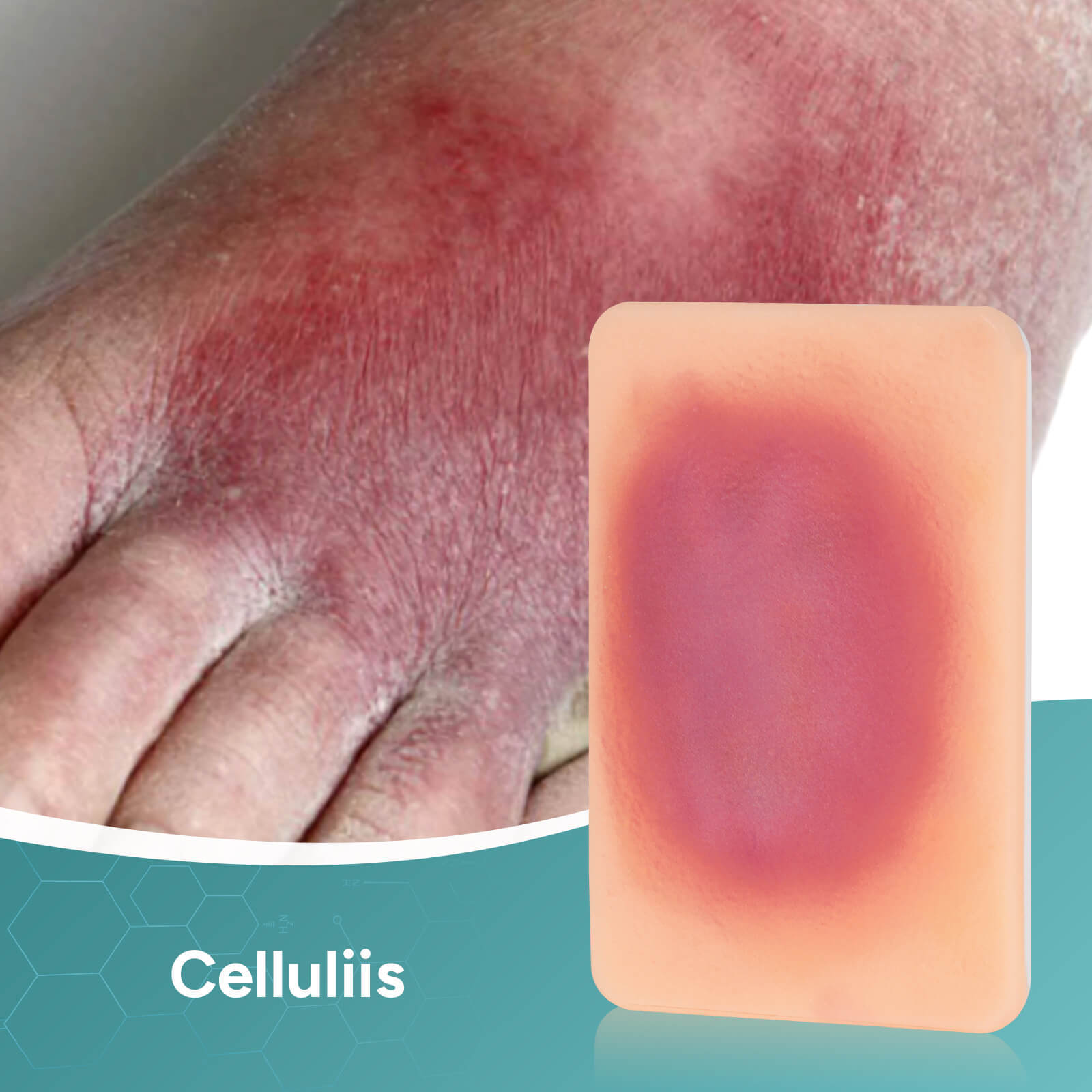 Palm-Sized Bacterial Skin Infection Wound Models