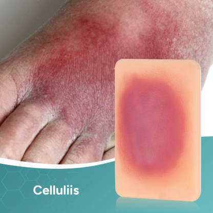 Palm-Sized Bacterial Skin Infection Wound Models