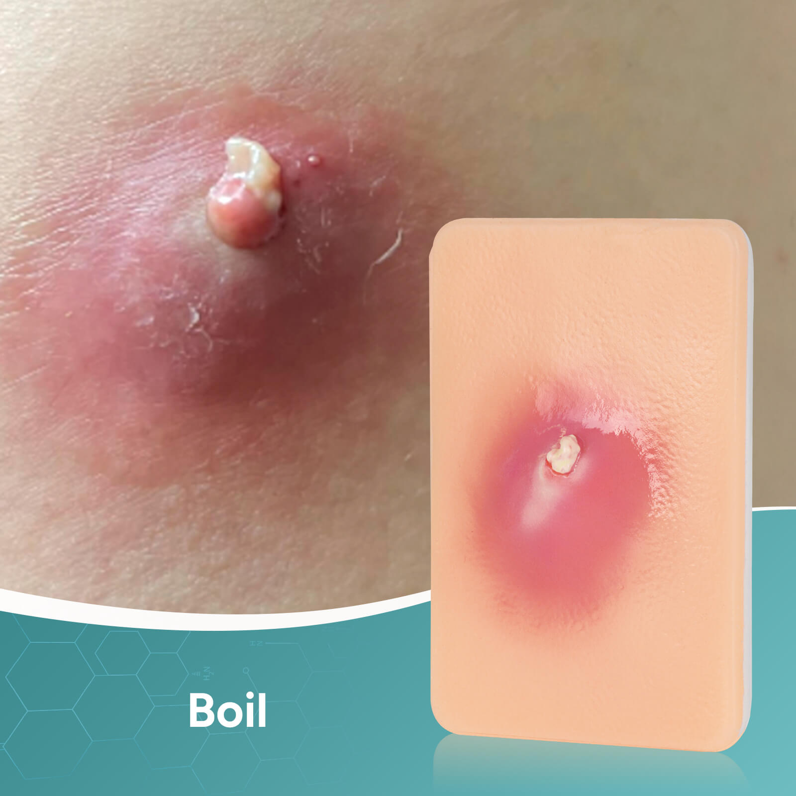 Palm-Sized Bacterial Skin Infection Wound Models